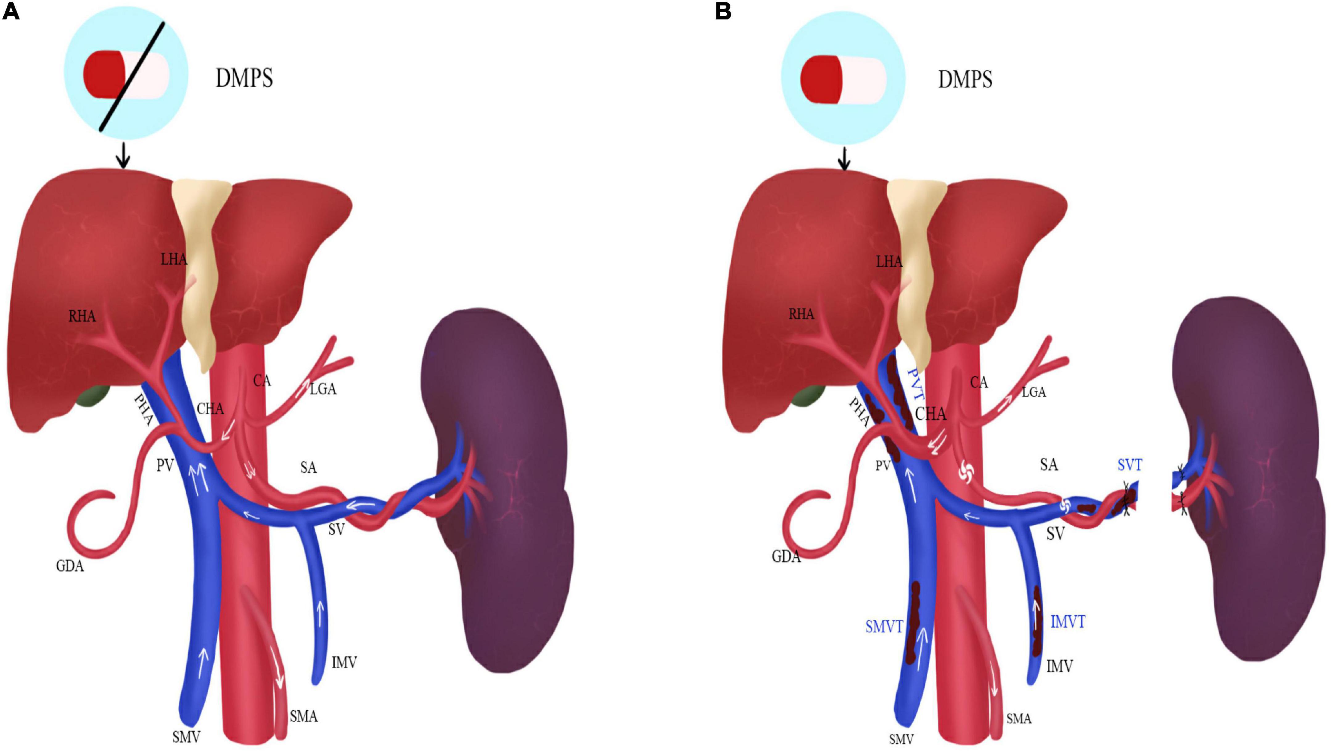 Nomogram-based prediction of portal vein system thrombosis formation after splenectomy in patients with hepatolenticular degeneration